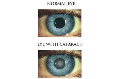 Cataracts — Knoxville, TN — Allee Vision Optometry