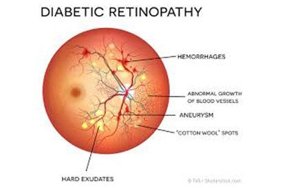 Diabetic Retinopathy — Knoxville, TN — Allee Vision Optometry