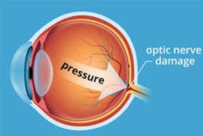 Glaucoma — Knoxville, TN — Allee Vision Optometry
