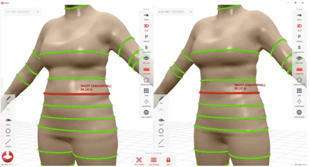 weight+loss+treatment