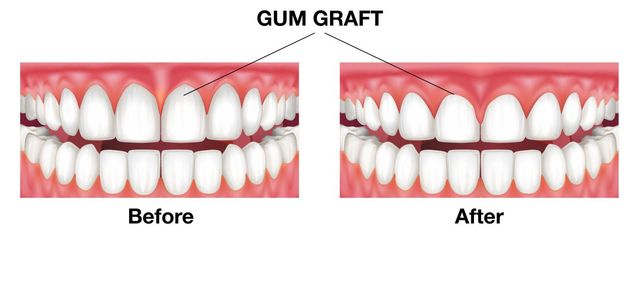 Gum Grafting Northshore Implant Perio Centre Vancouver Periodontal Surgical Centre