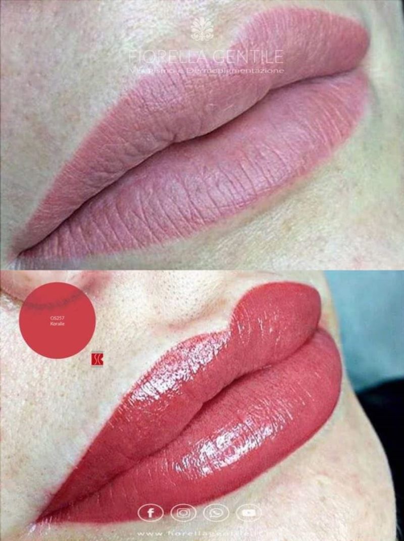 correzione labbra troppo sottili
