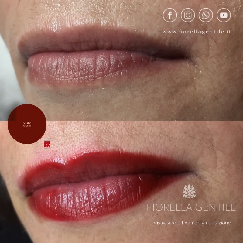 correzione asimmetria nelle labbra