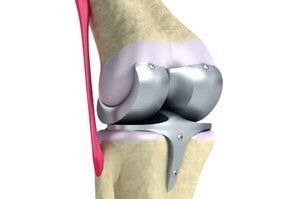 Knee Replacement - Rehab Services in Saint John IN