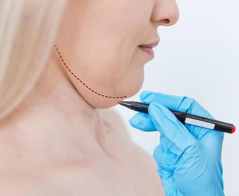 FILLER DISSOLVER Tampa