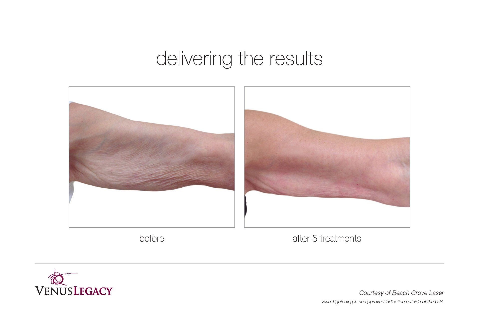 Woman Hand Before And After 5 Treatment — Beach, FL — Skinny Jax