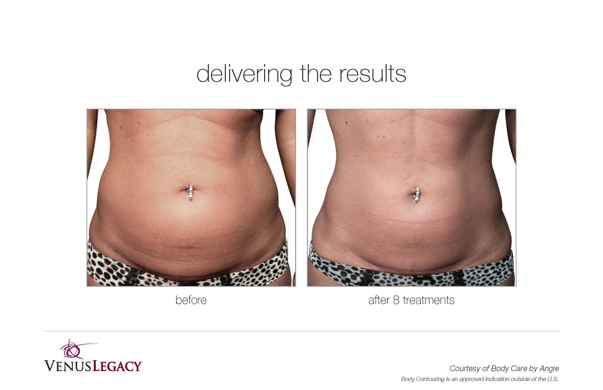 Woman Stomach  After 8 Treatment — Beach, FL — Skinny Jax