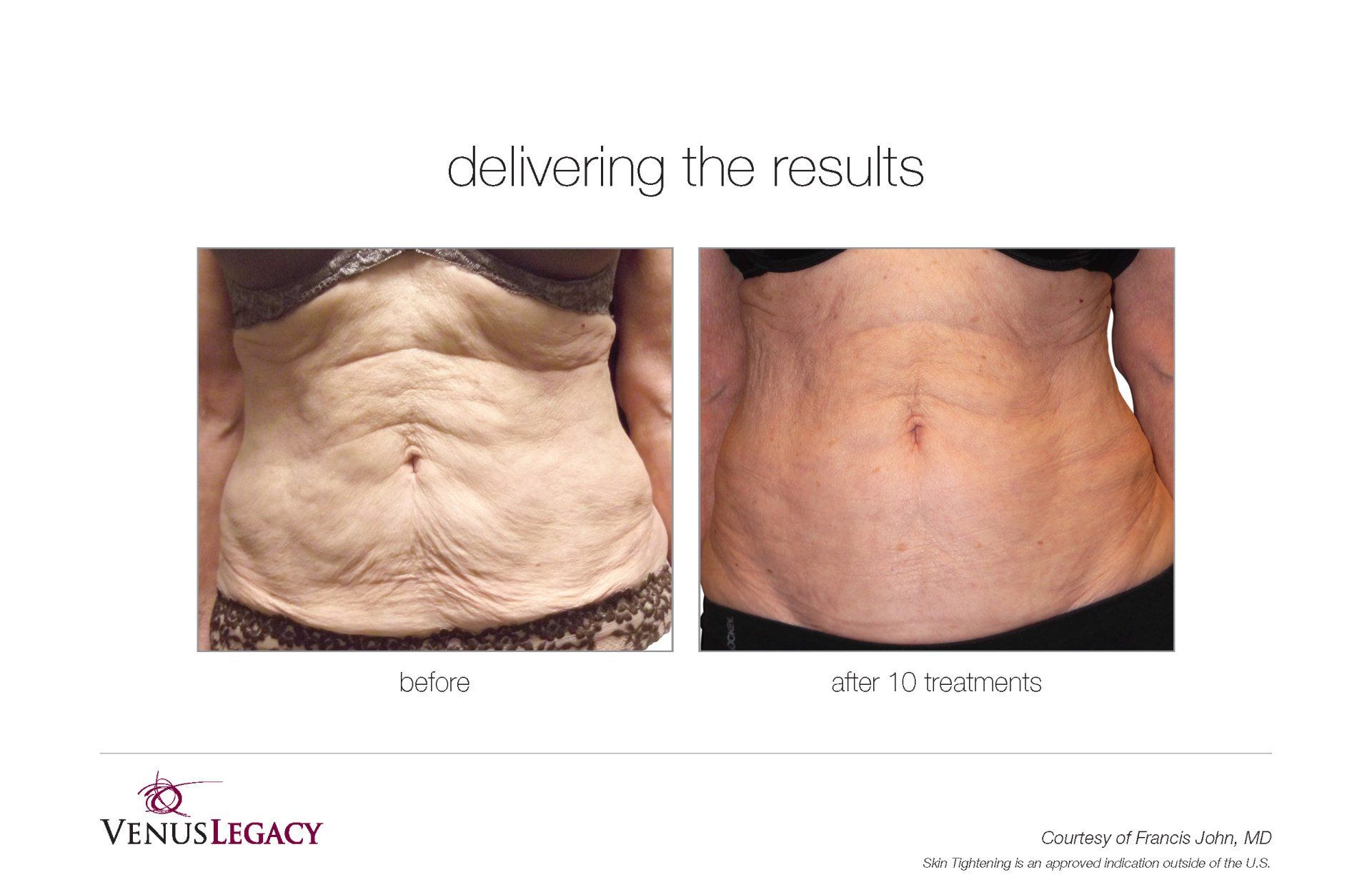 Front View Stomach With  After 10 Treatment — Beach, FL — Skinny Jax