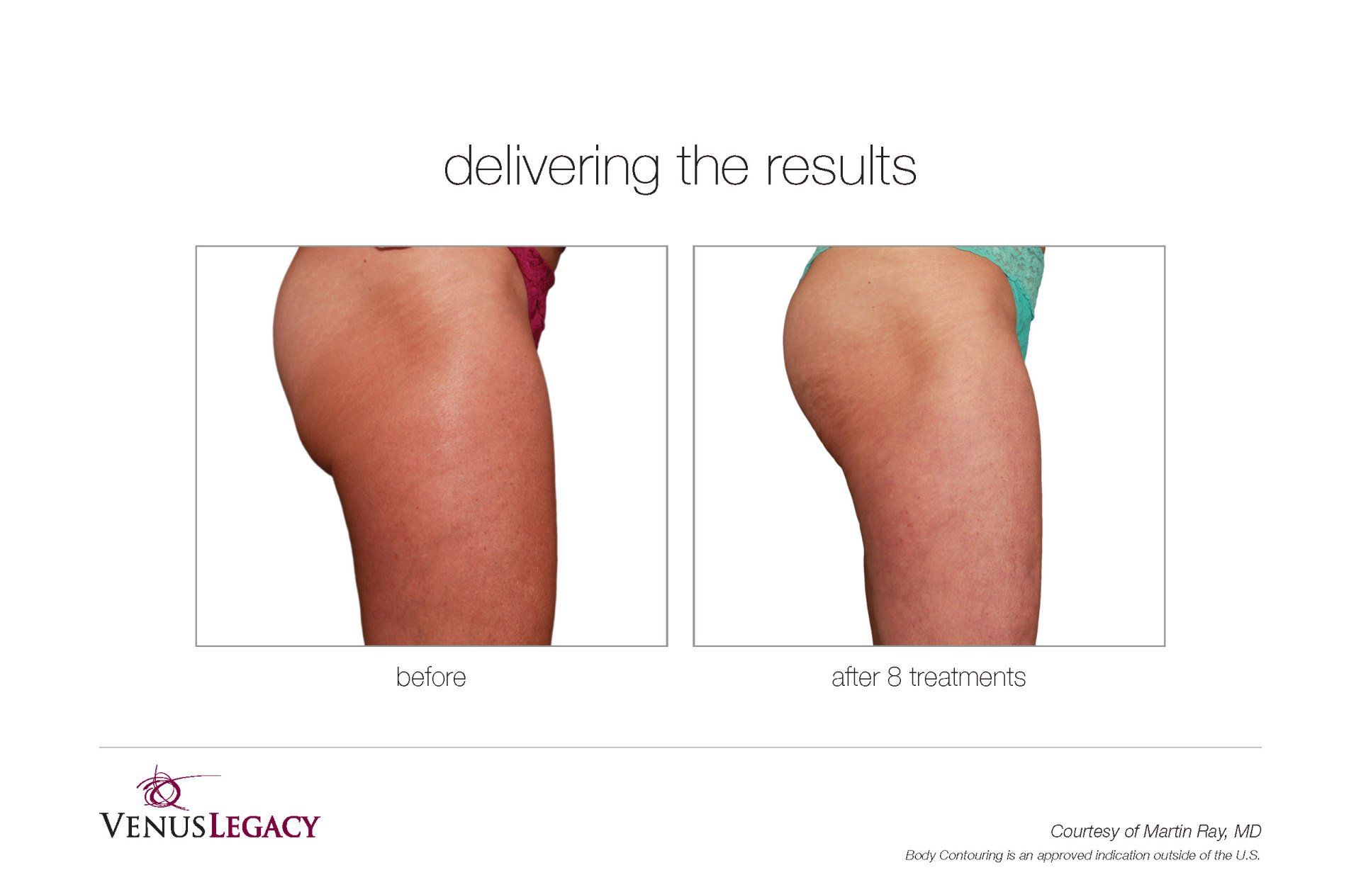 Woman Thigh Before And  After 8 Treatment — Beach, FL — Skinny Jax
