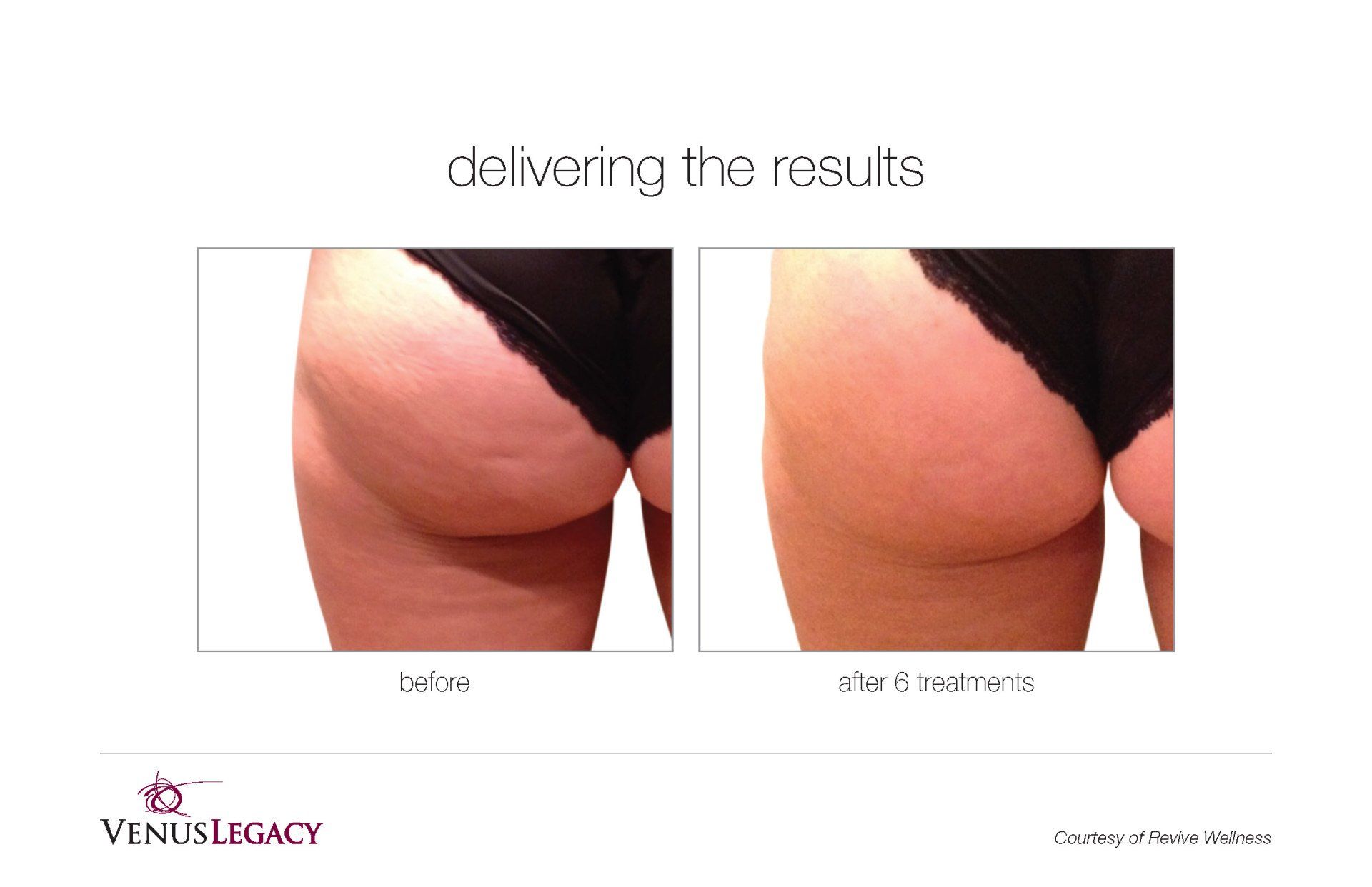 Half Back View Before And After Treatment — Beach, FL — Skinny Jax