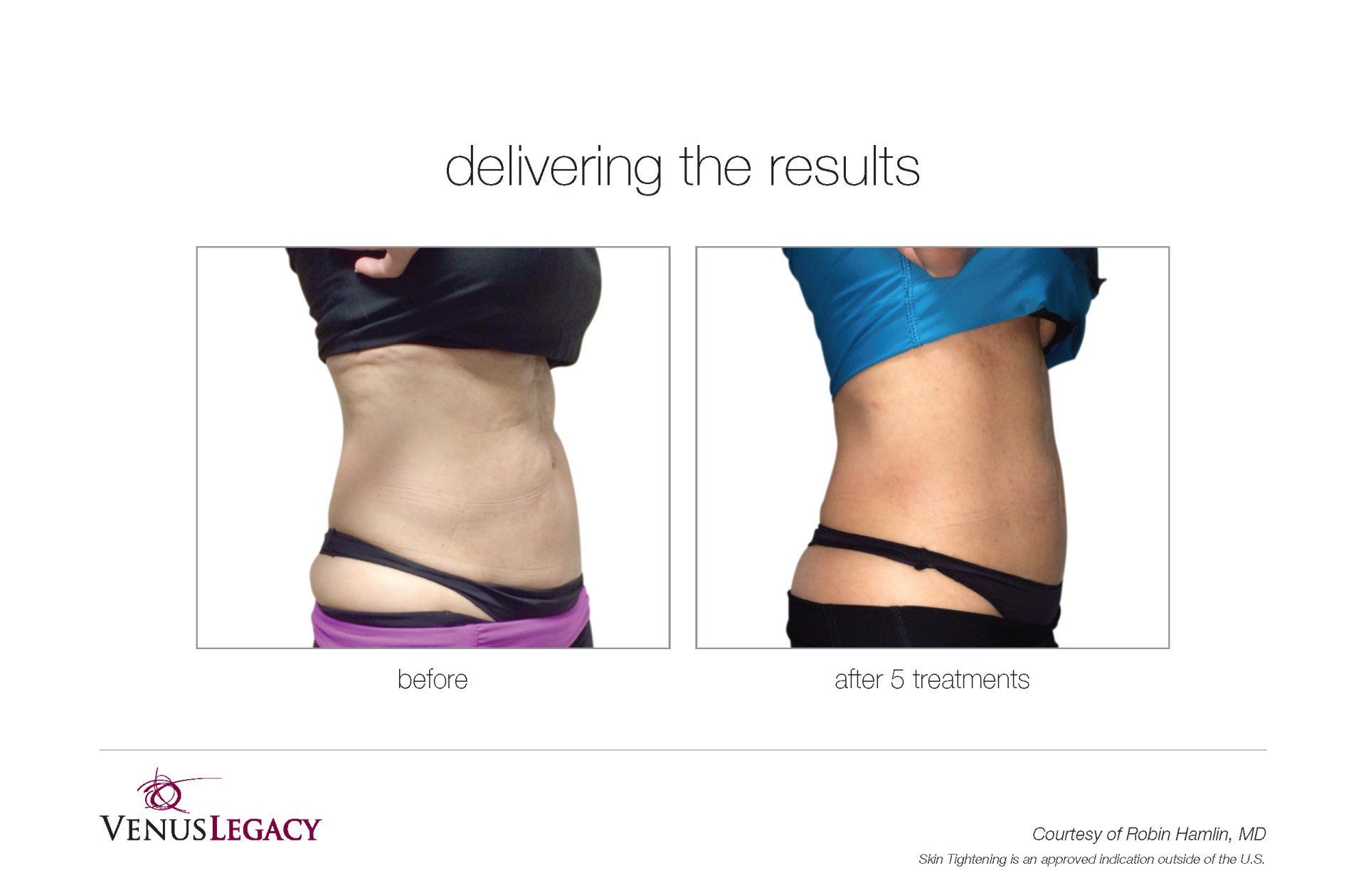 Flat Stomach Before And After Treatment — Beach, FL — Skinny Jax