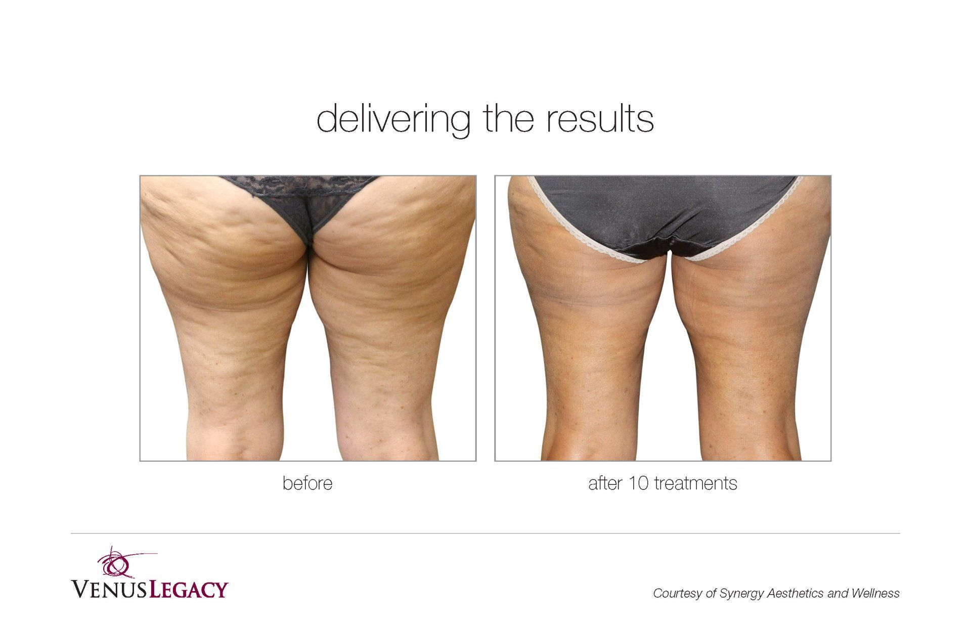 Back View Before And After Treatment — Beach, FL — Skinny Jax