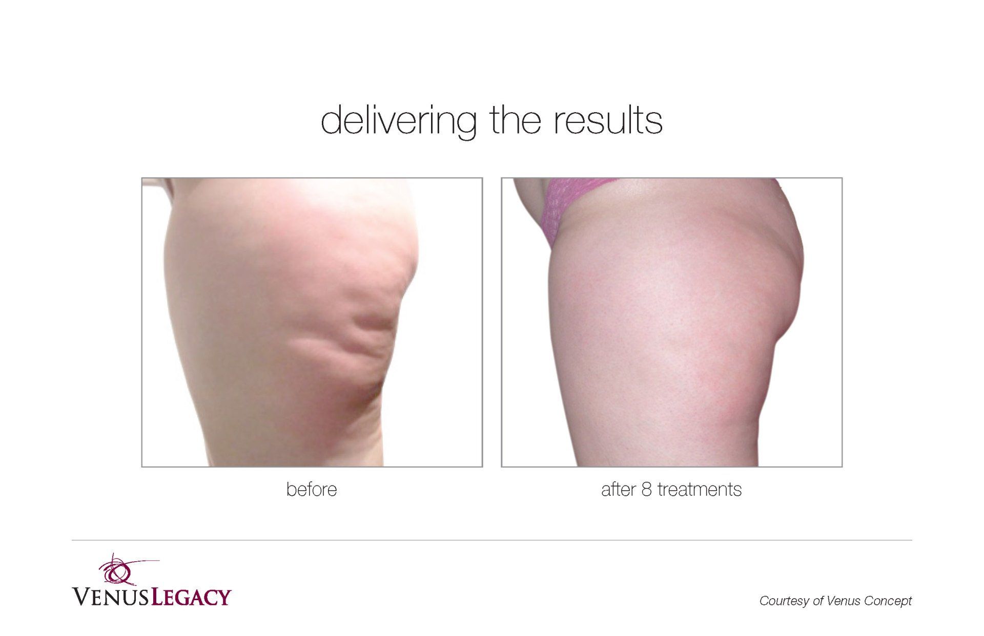 Legs Side View Before And After Treatment — Beach, FL — Skinny Jax