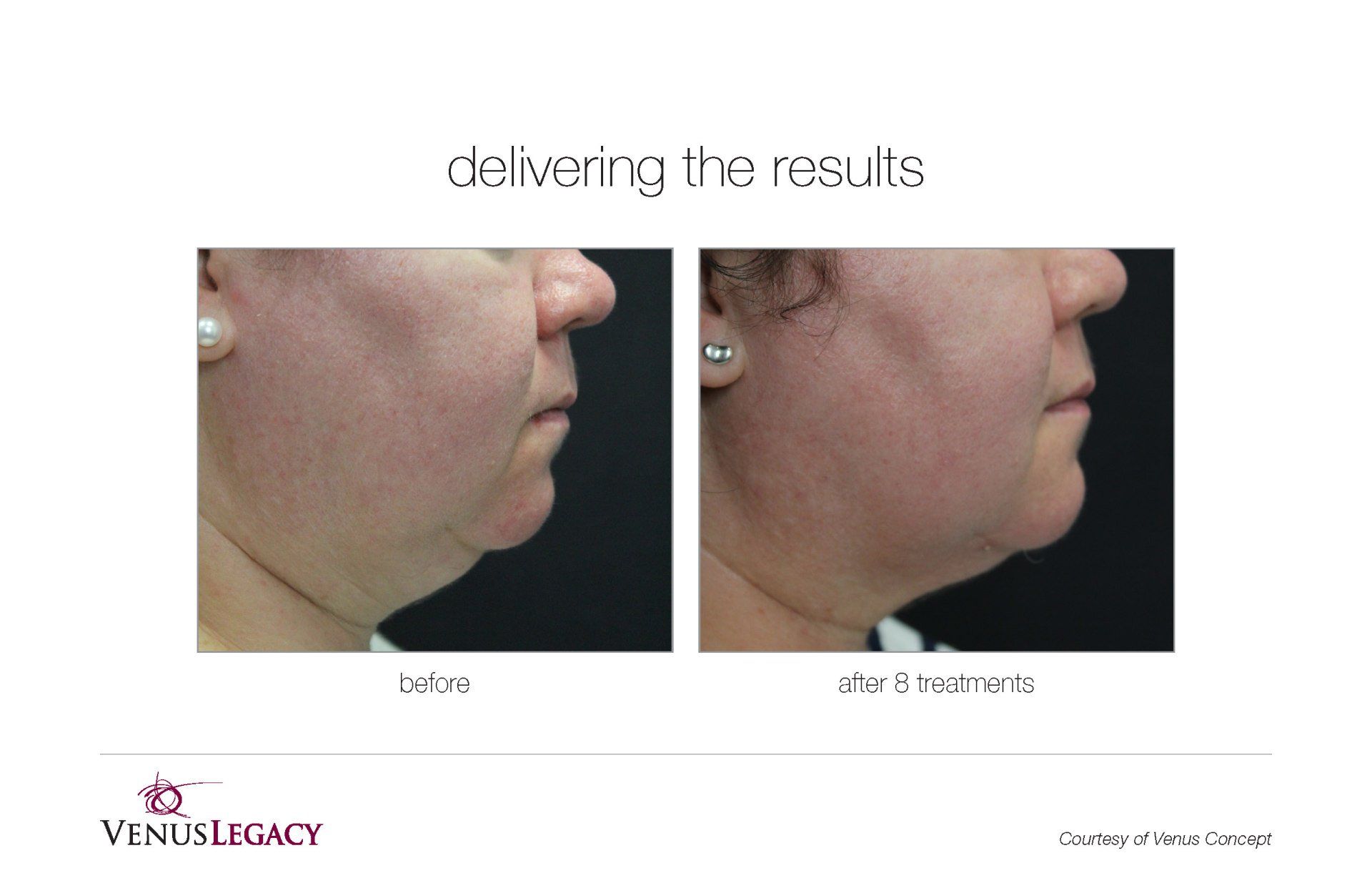 Face Side View Before And After Treatment — Beach, FL — Skinny Jax