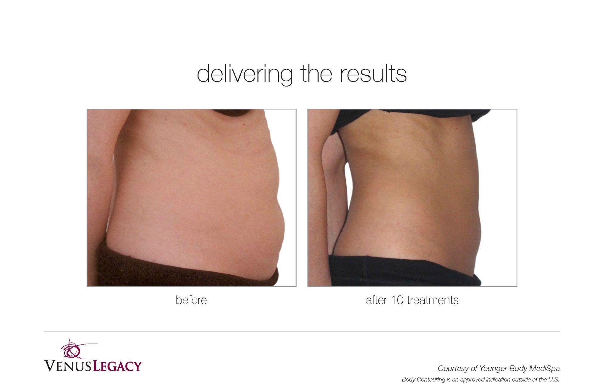 Stomach Before And After Treatment — Beach, FL — Skinny Jax