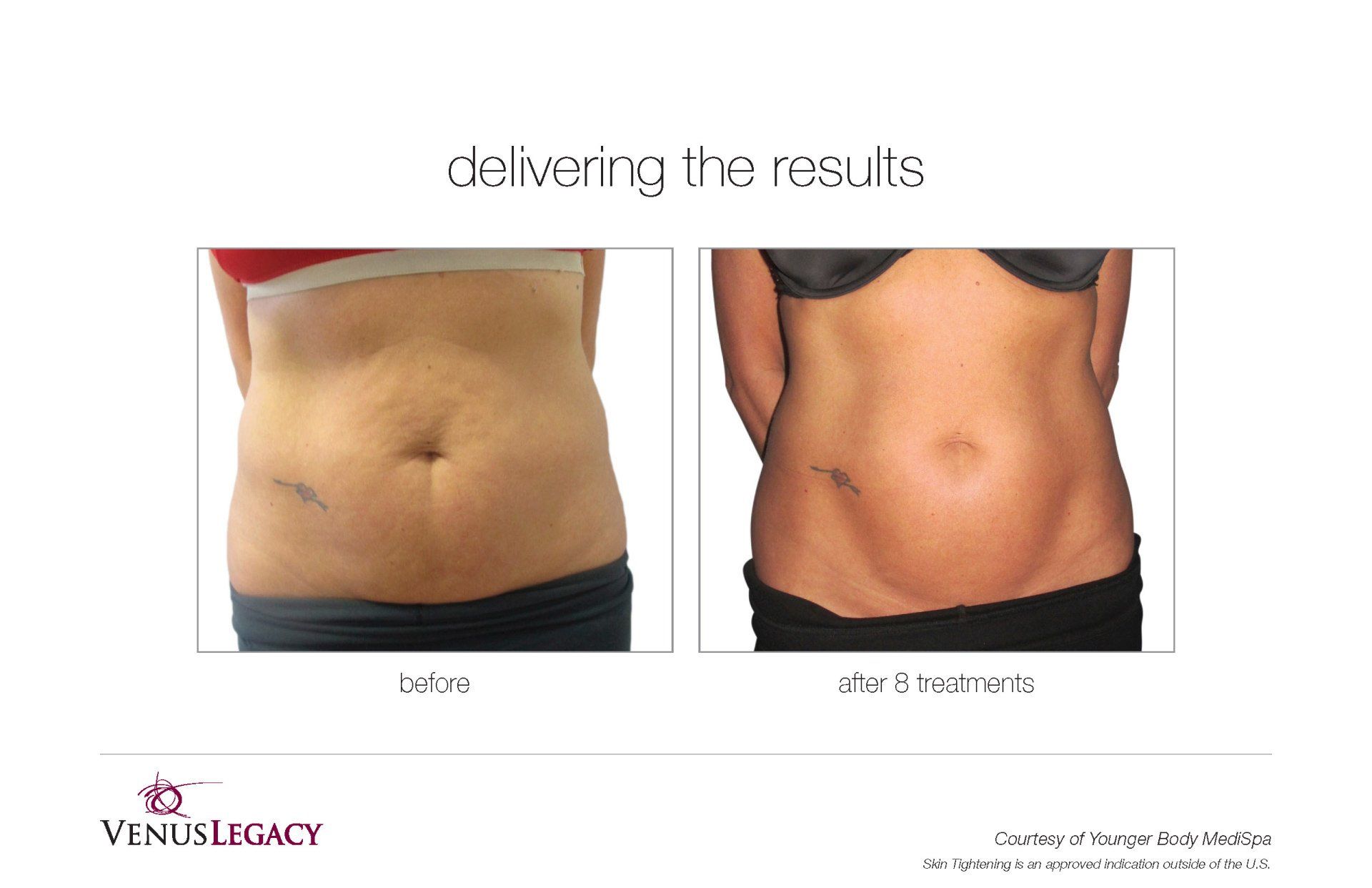 Front View Stomach Before And After Treatment — Beach, FL — Skinny Jax