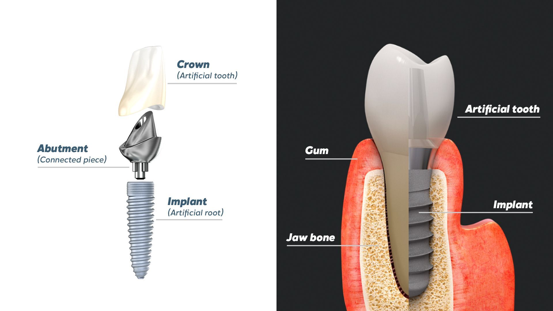 Model dental implant, showing a tooth implant, adjacent teeth, and a detached crown.