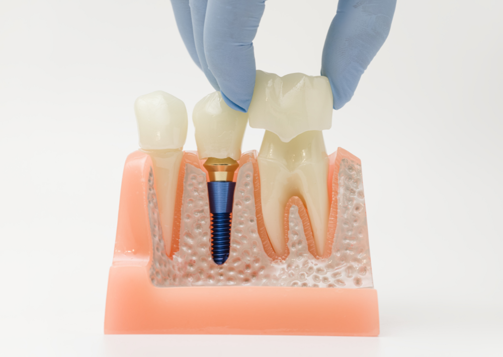 Woman demonstrating areas for cosmetic injections: frown lines, crow's feet, jawline.