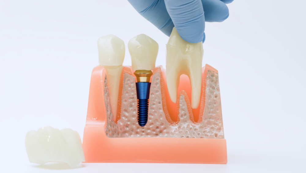 Woman demonstrating areas for cosmetic injections: frown lines, crow's feet, jawline.