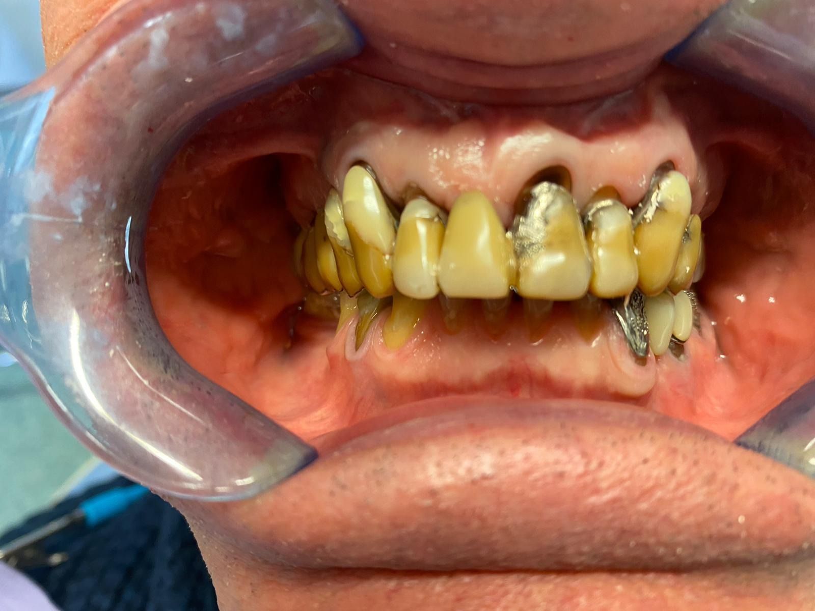 Primo piano dei denti di una persona con un paradenti.