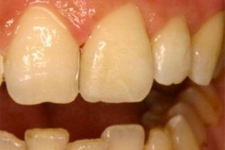 Un primo piano dei denti di una persona con le gengive rosse.