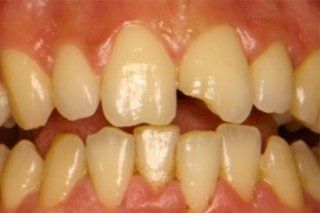 Un primo piano dei denti di una persona con un dente rotto.