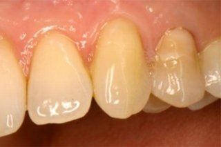 Un primo piano dei denti di una persona con alcune macchie bianche.