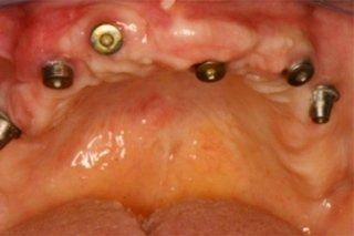 Un primo piano della bocca di una persona con impianti dentali al suo interno