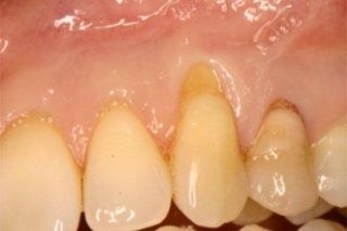 Un primo piano dei denti e delle gengive di una persona.