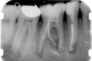 Una radiografia di un dente con un buco