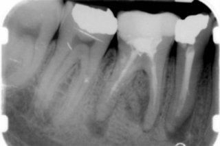Una radiografia in bianco e nero dei denti di una persona.