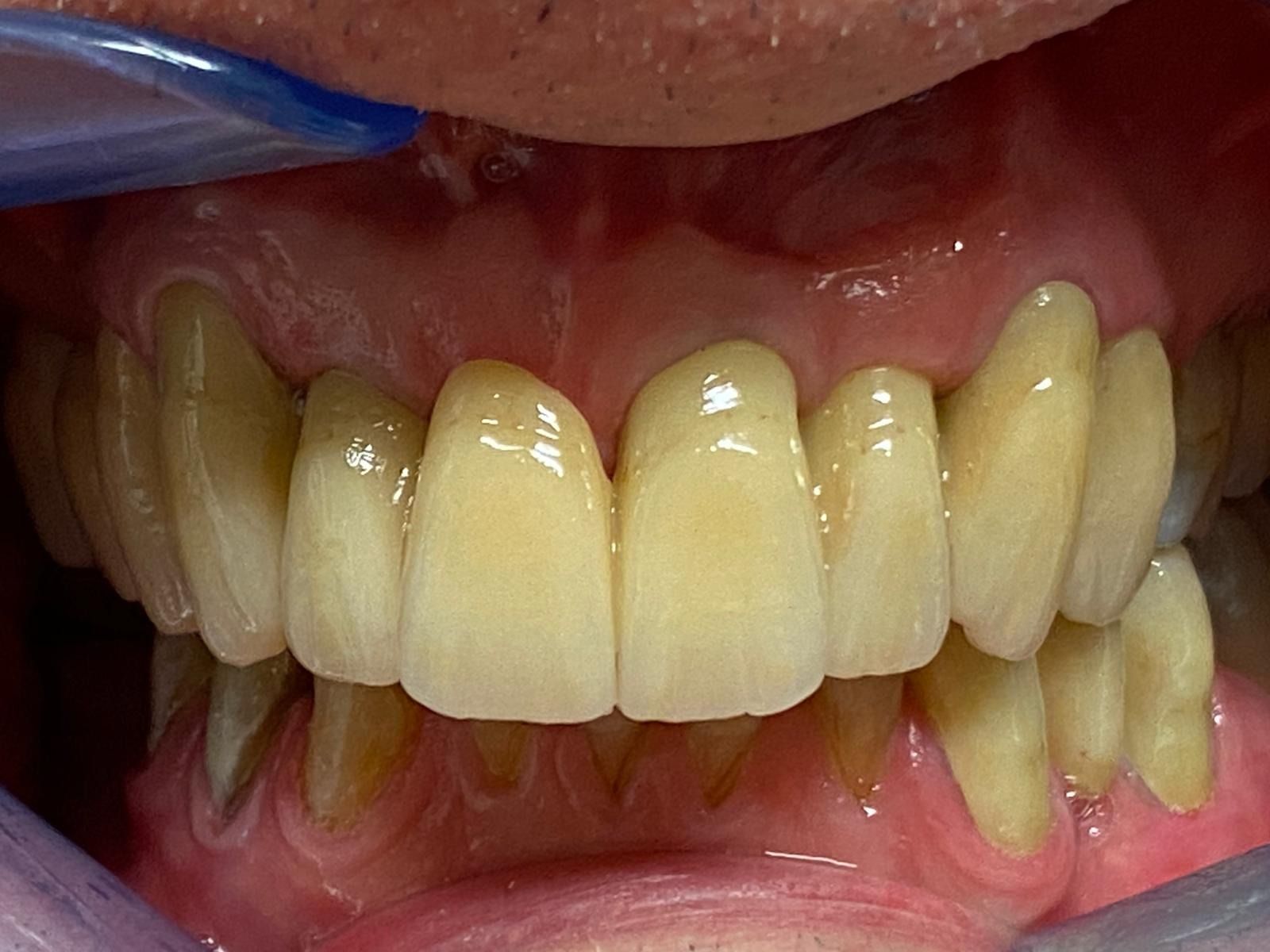 Un primo piano dei denti di una persona con uno spazzolino da denti in bocca.
