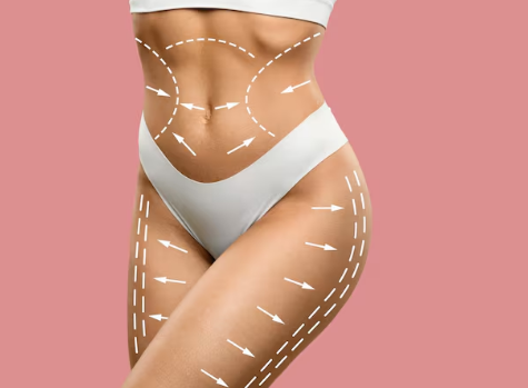 Lipoaspiração HD com técnica avançada para definição corporal em SP