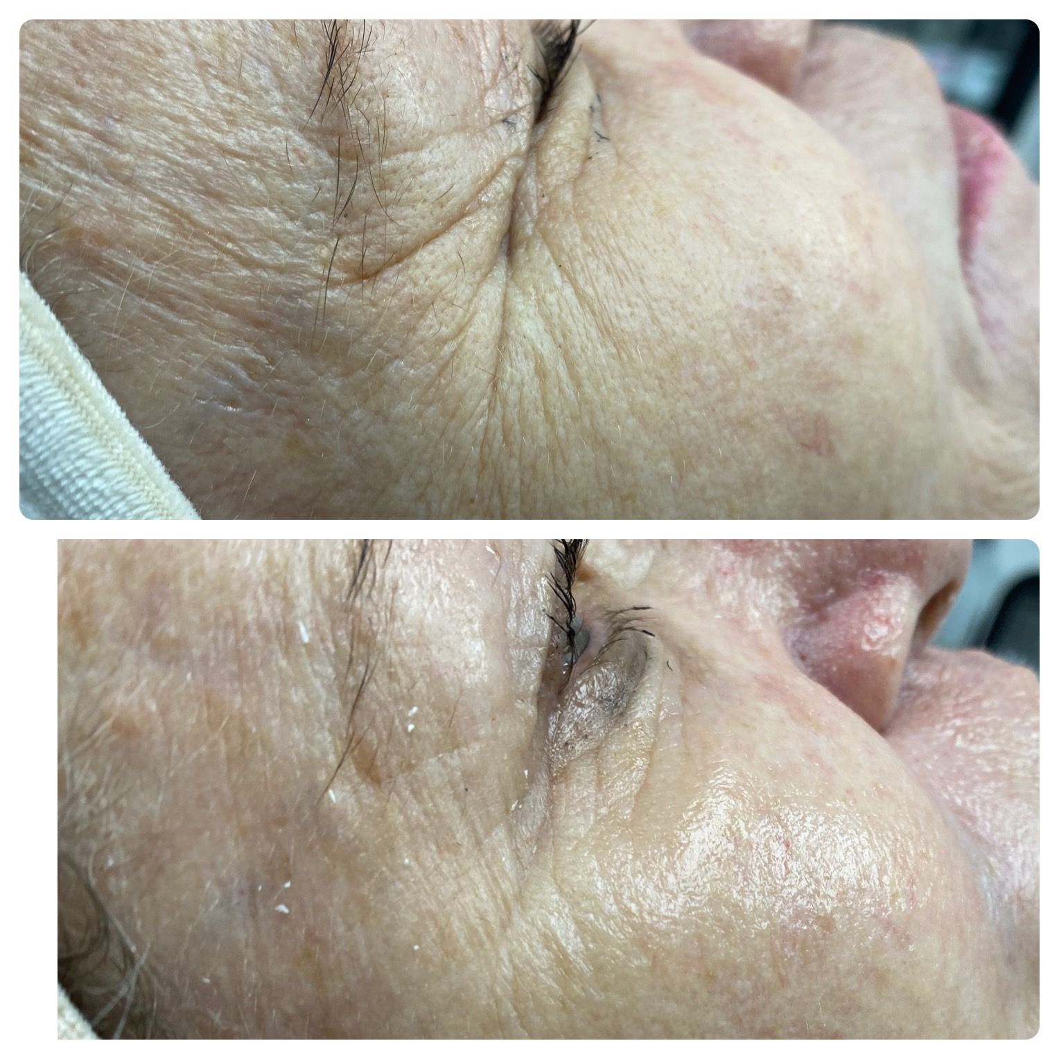 Two close-up photos of facial skin; top shows wrinkles, bottom shows smoother skin.
