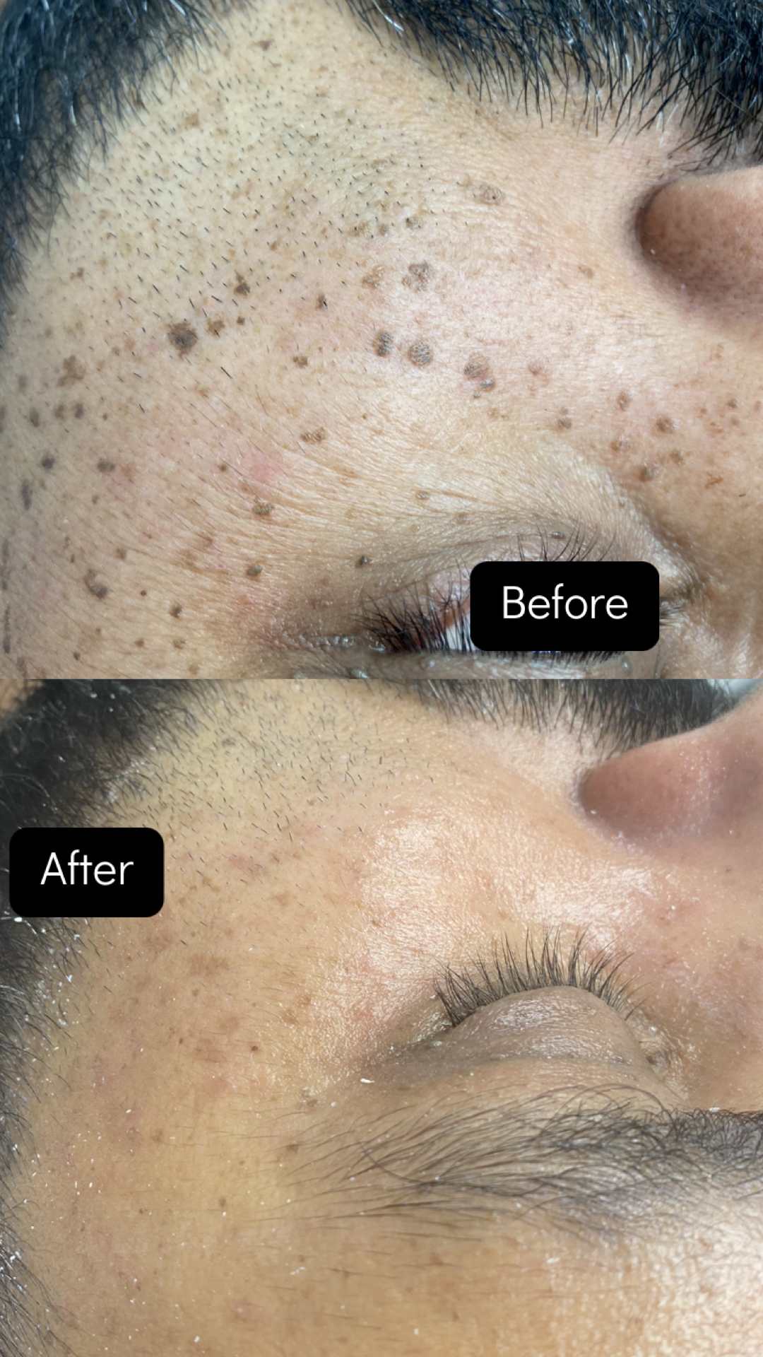 Comparison: Face before and after treatment, showing reduction in dark spots.