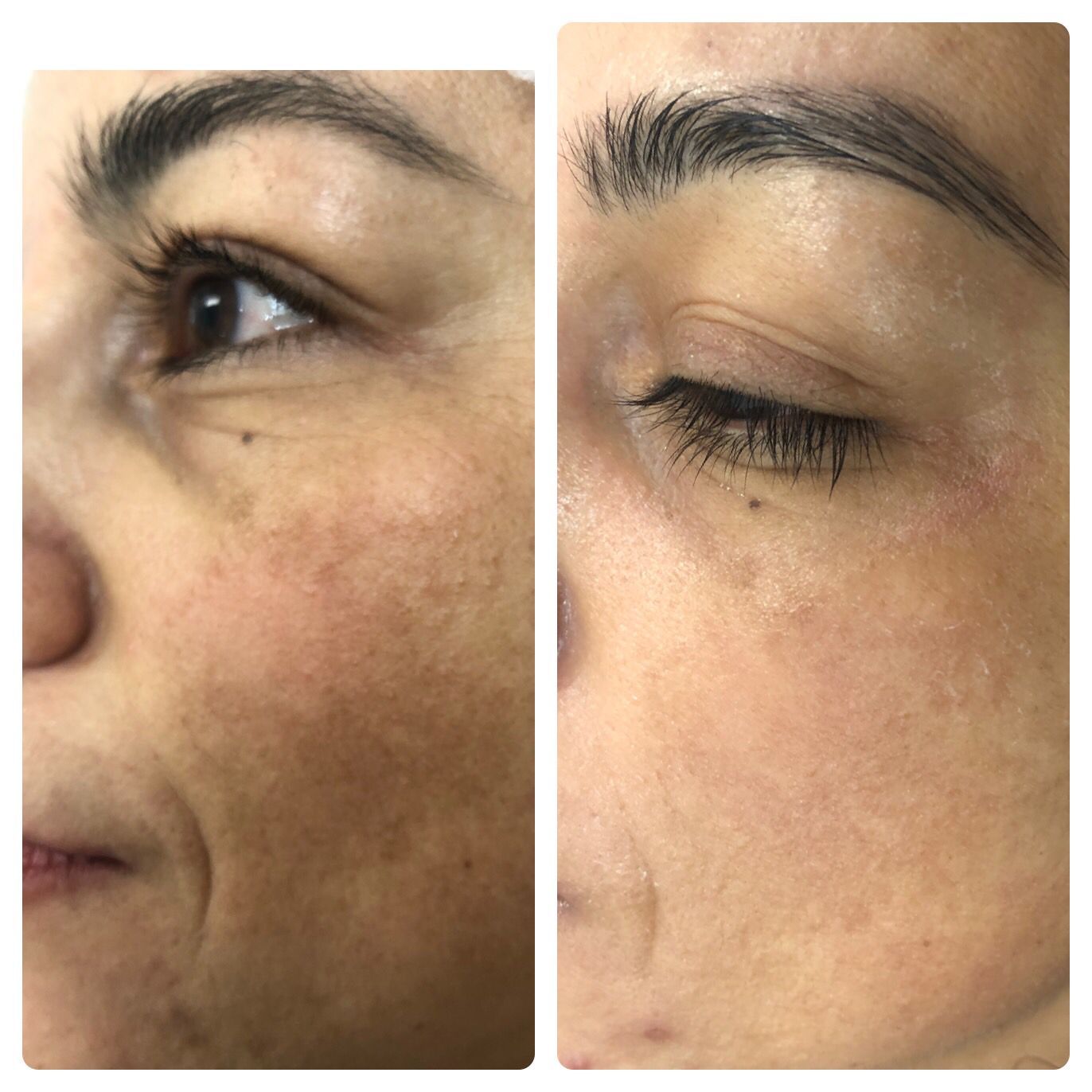 Two close-up photos of a person's face. Left shows skin with dark spots. Right shows similar skin.