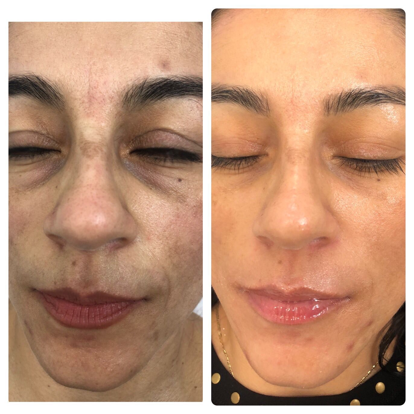 Before-and-after facial view. Skin tone appears improved. Fine lines and dark spots reduced after treatment.