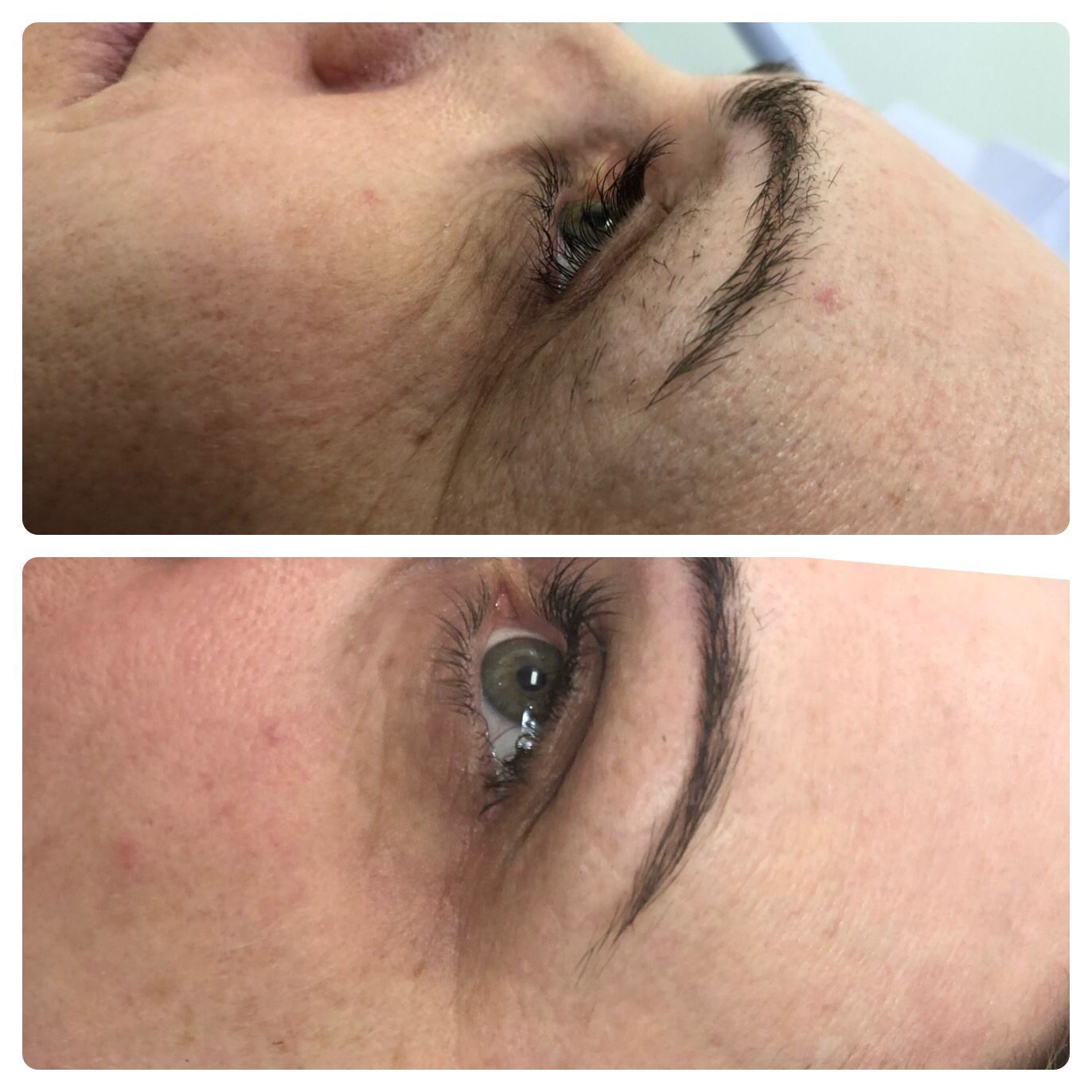 Comparison of a person's eye and surrounding skin before (top) and after (bottom) a procedure, with fewer wrinkles.