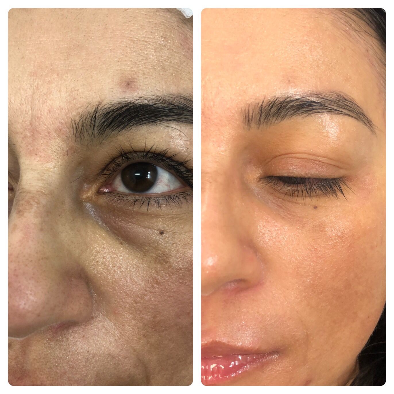 Before and after view of a person's face; skin texture improvement with reduced wrinkles and spots.