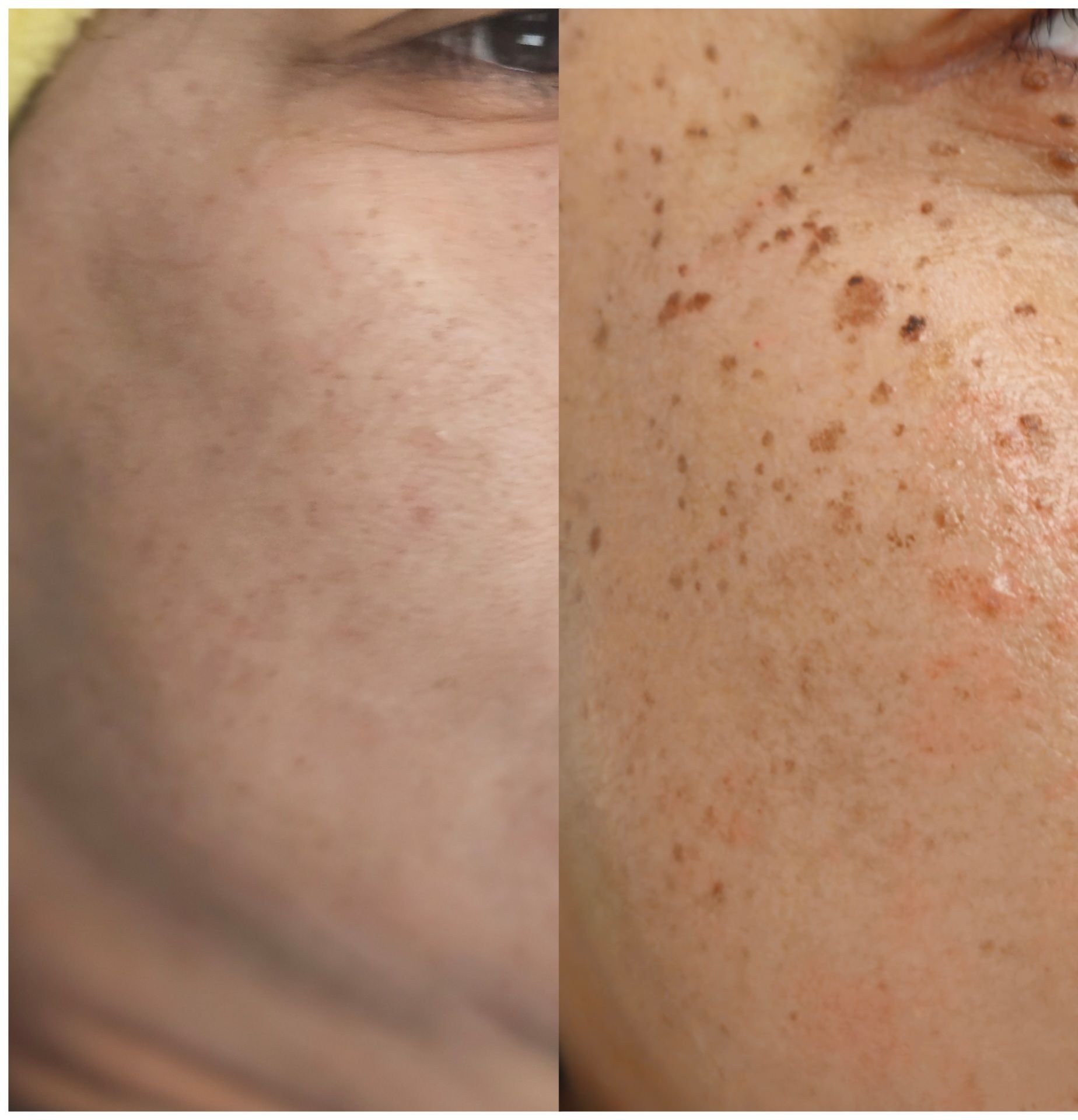Before and after view of skin with reduced dark spots.