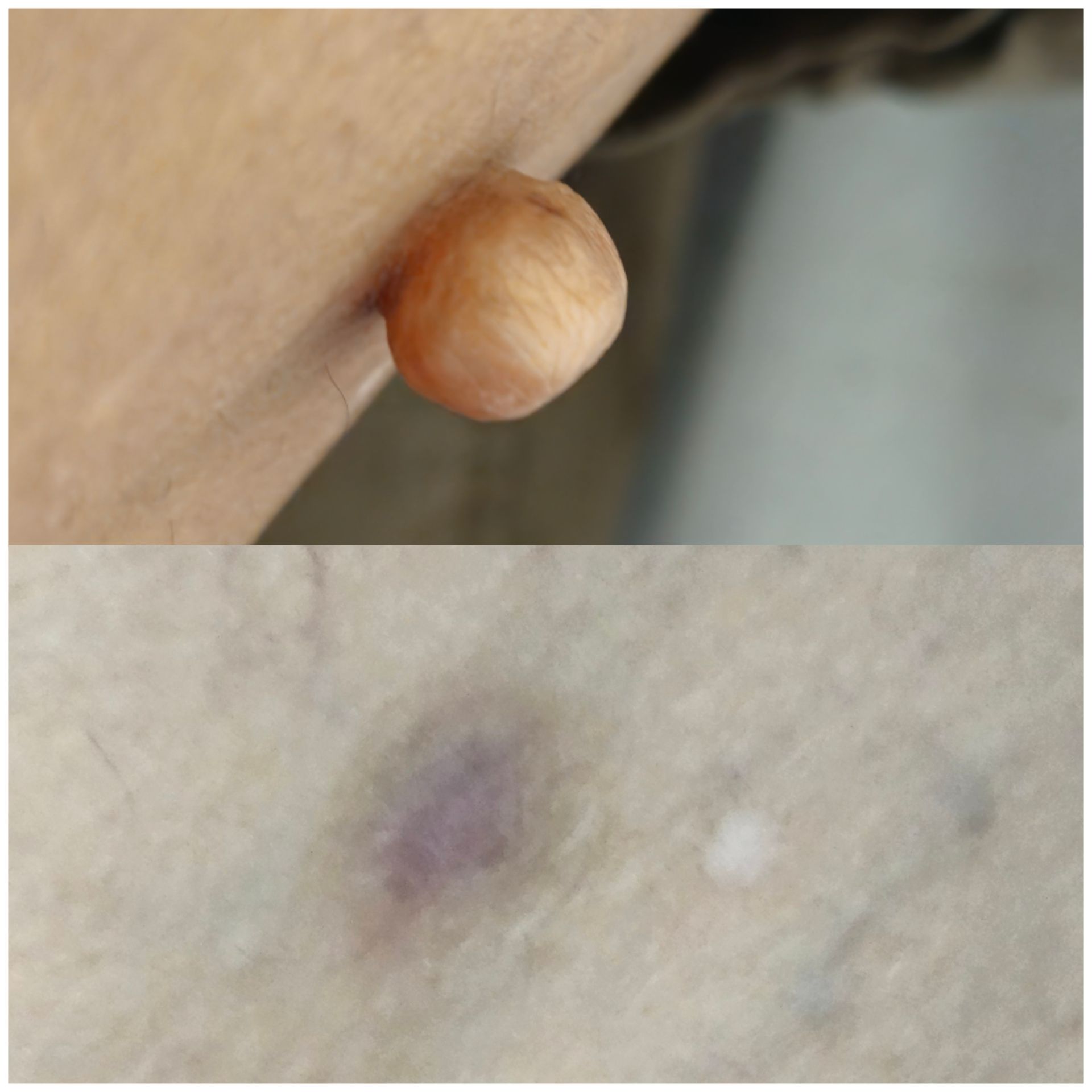 Top: A tan, round, raised bump on skin. Bottom: A small, purple bruise on skin.