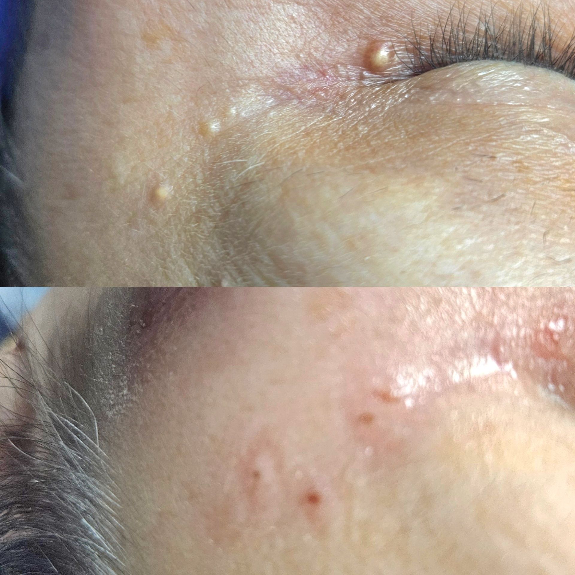 Top: Close-up of eye with several raised, yellowish bumps. Bottom: Skin with small, brownish marks.