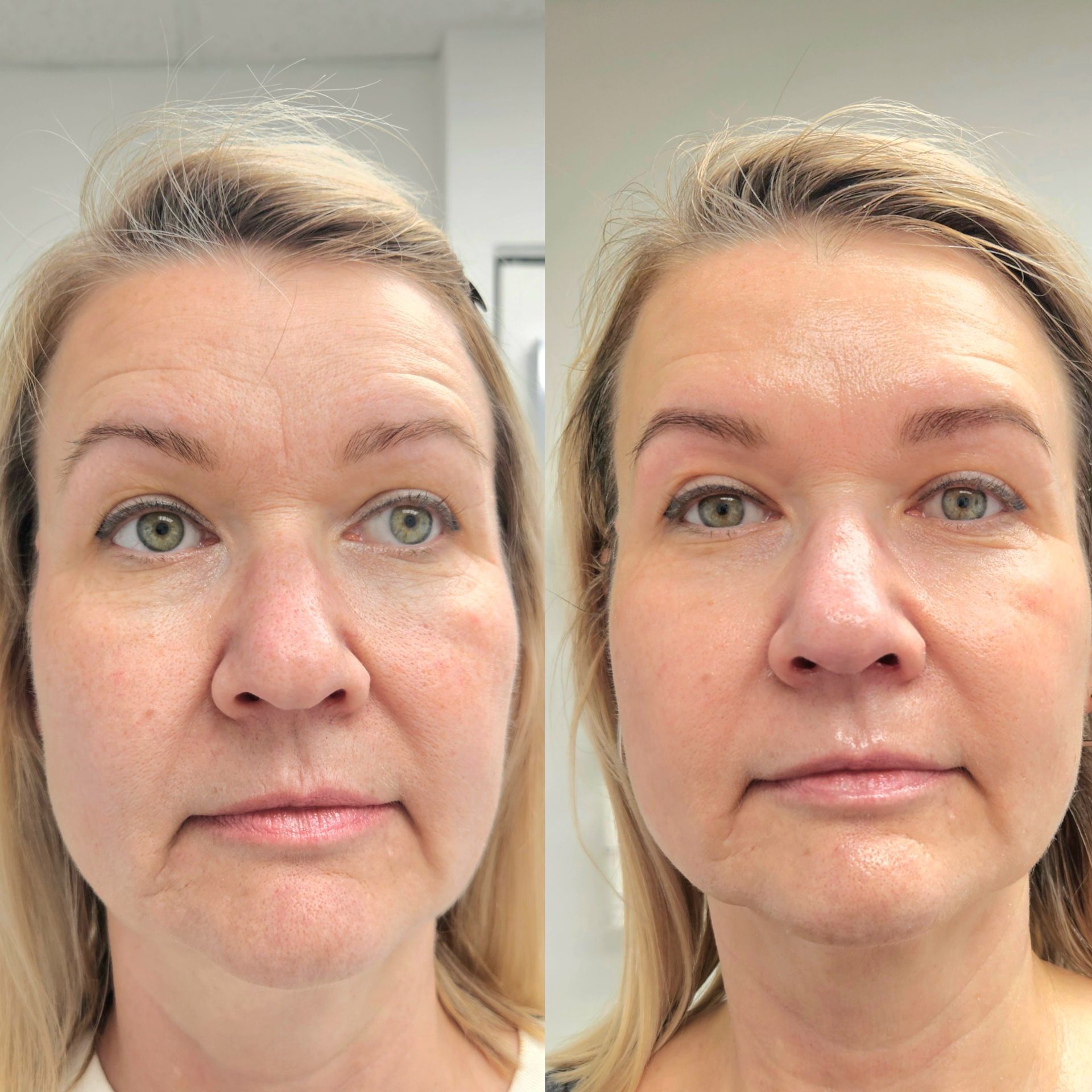 Side-by-side comparison of a person's face before and after a cosmetic procedure, with reduced wrinkles.