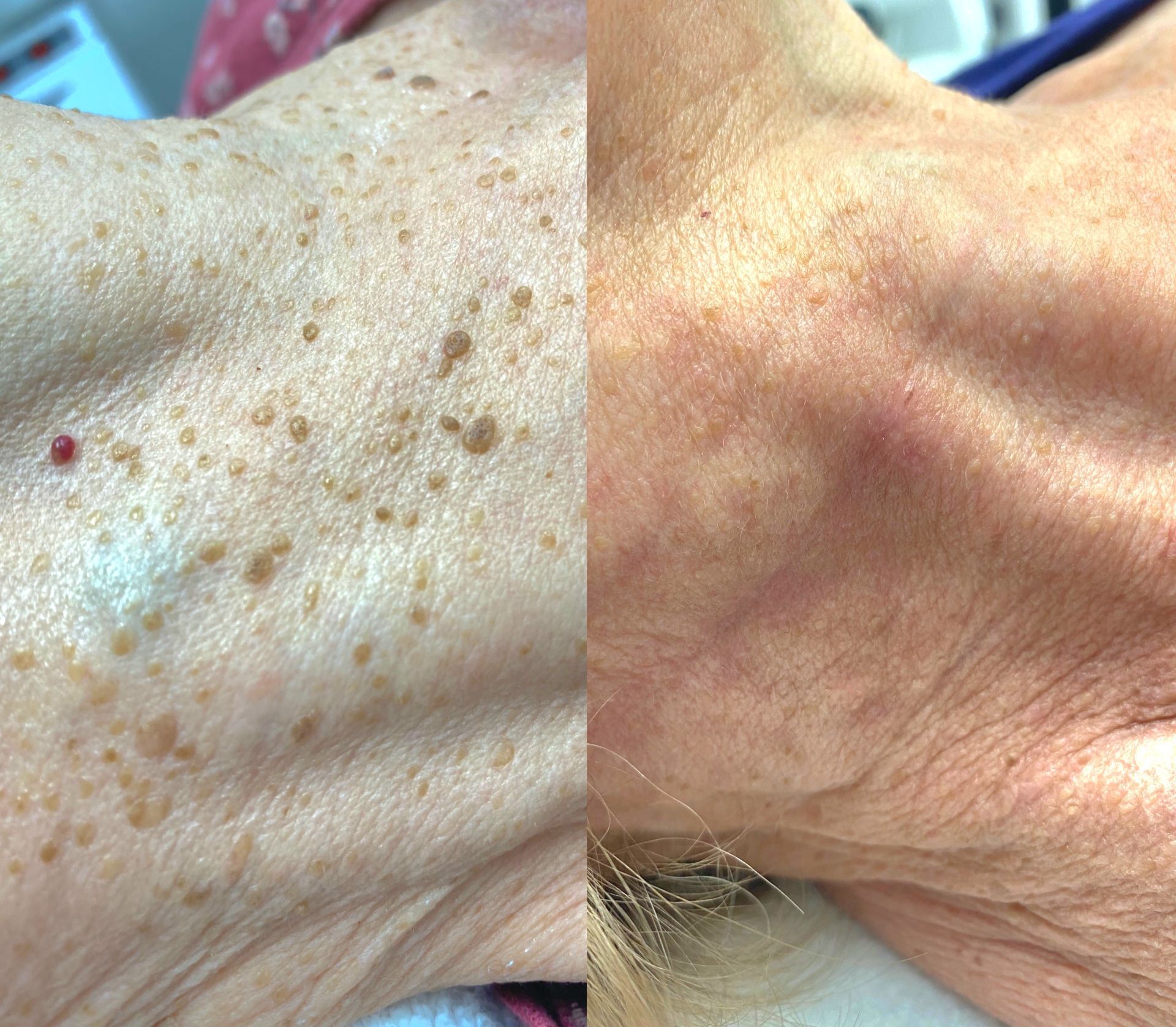 Side-by-side comparison of skin before and after treatment, reducing brown spots and raised lesions on the neck.