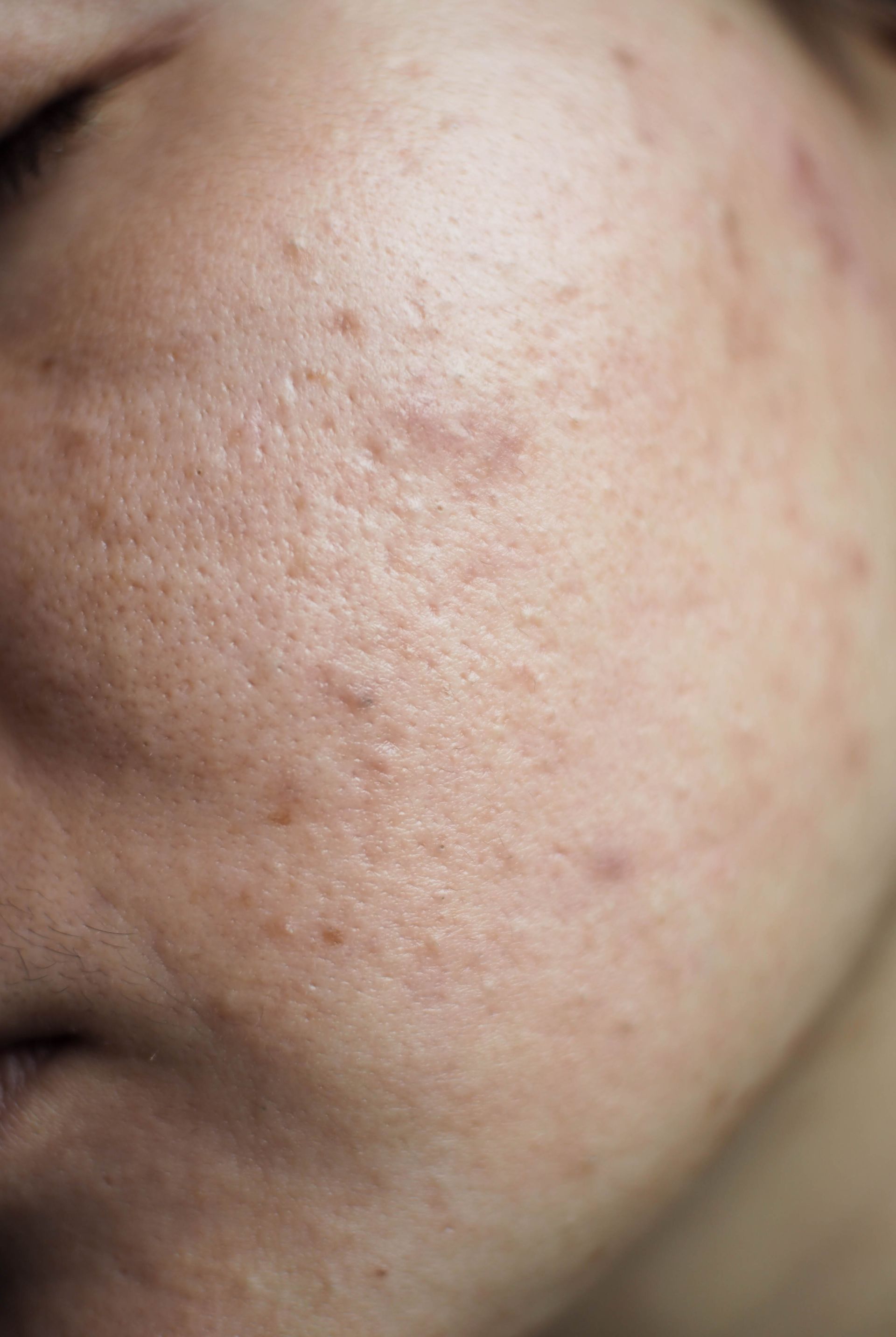 Close-up of a person's face showing uneven skin texture, pores, and acne scars.