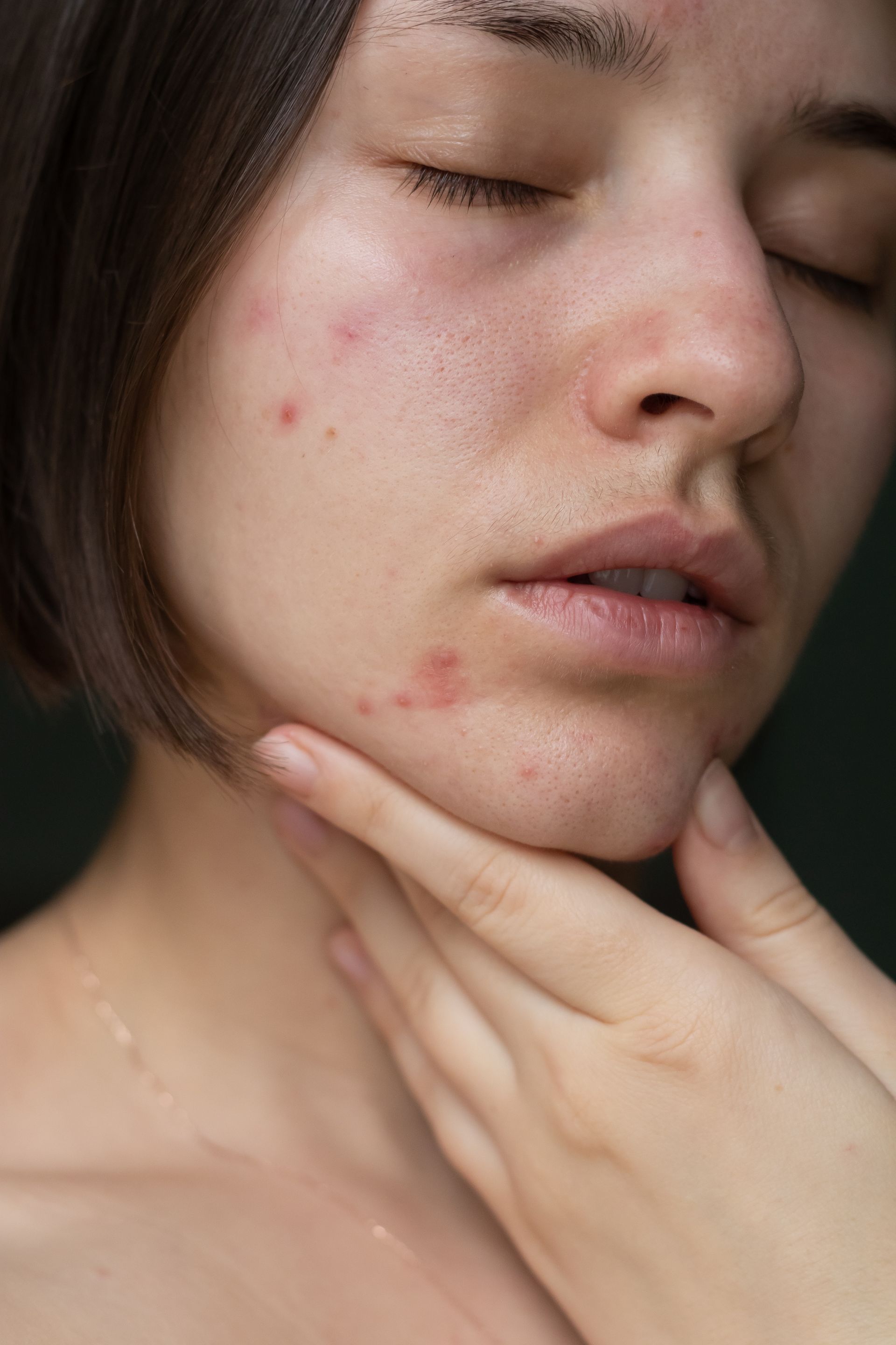 Woman with closed eyes and acne, touching her neck.