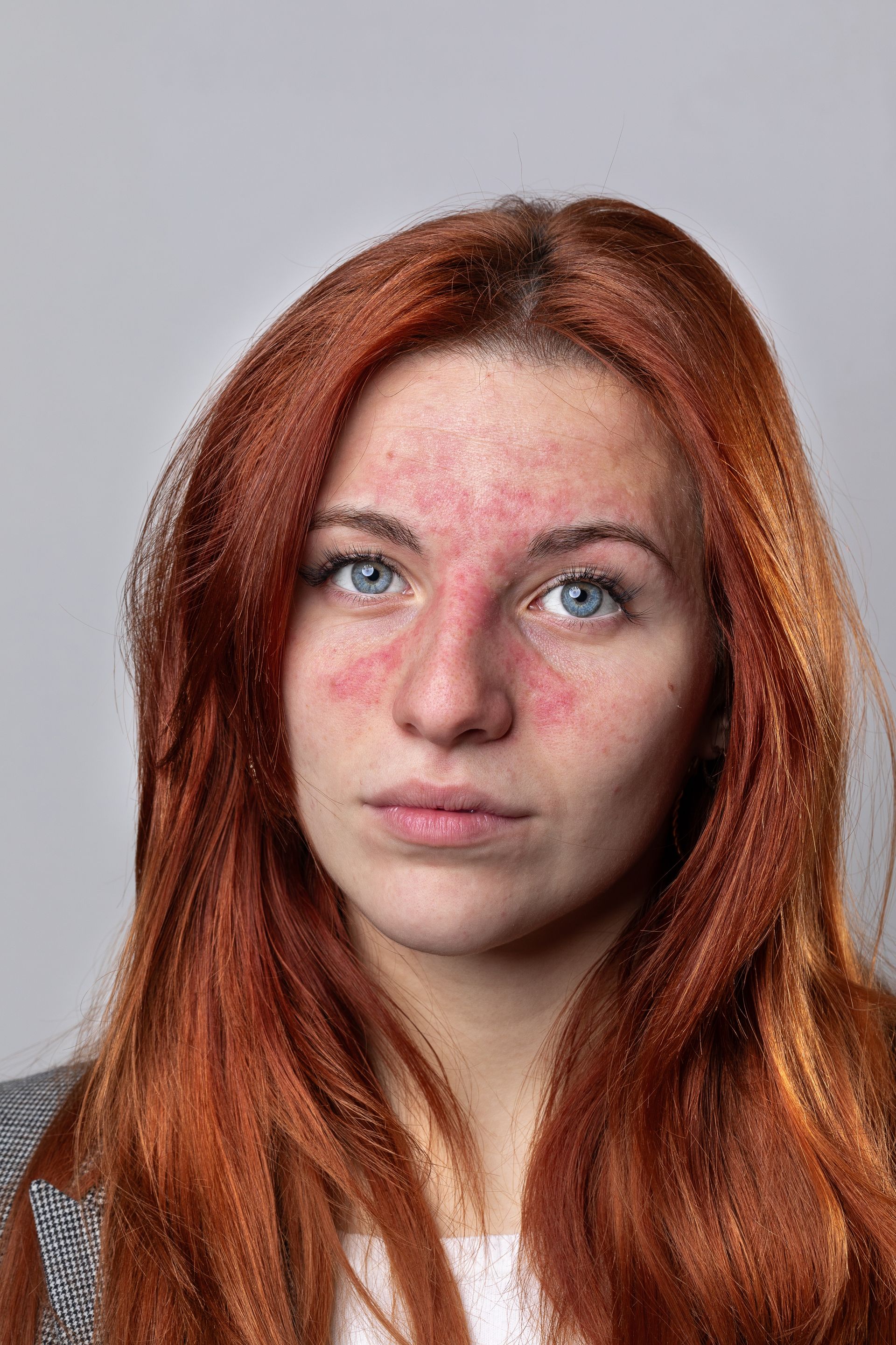 Woman with red hair, visible rosacea on cheeks and nose, looking at the viewer.