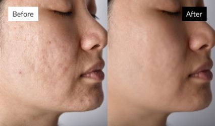 3-Acne scars