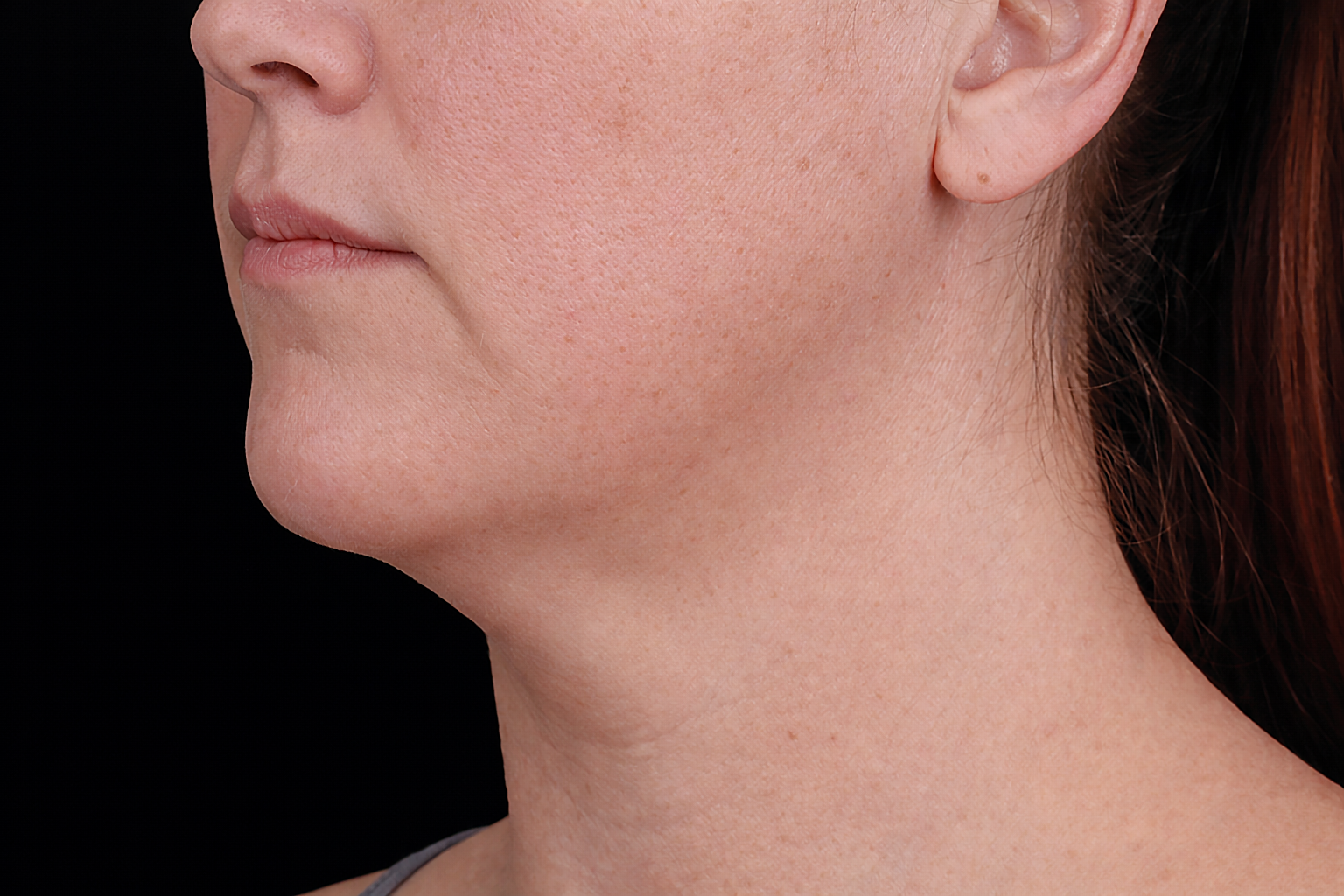 Profile view of a person's face and neck, with visible skin laxity under the chin.