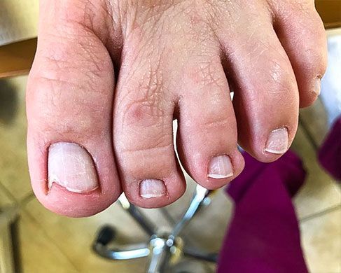 Foot Treatment After 7